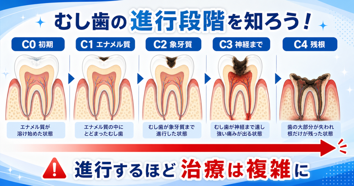痛みが消えたのはなぜ？むし歯を放置するリスクと「痛まなくなる」医学的理由
