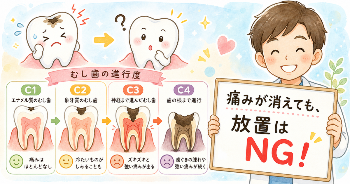 むし歯の痛みが消えた？放置するとどうなるか進行度別に徹底解説