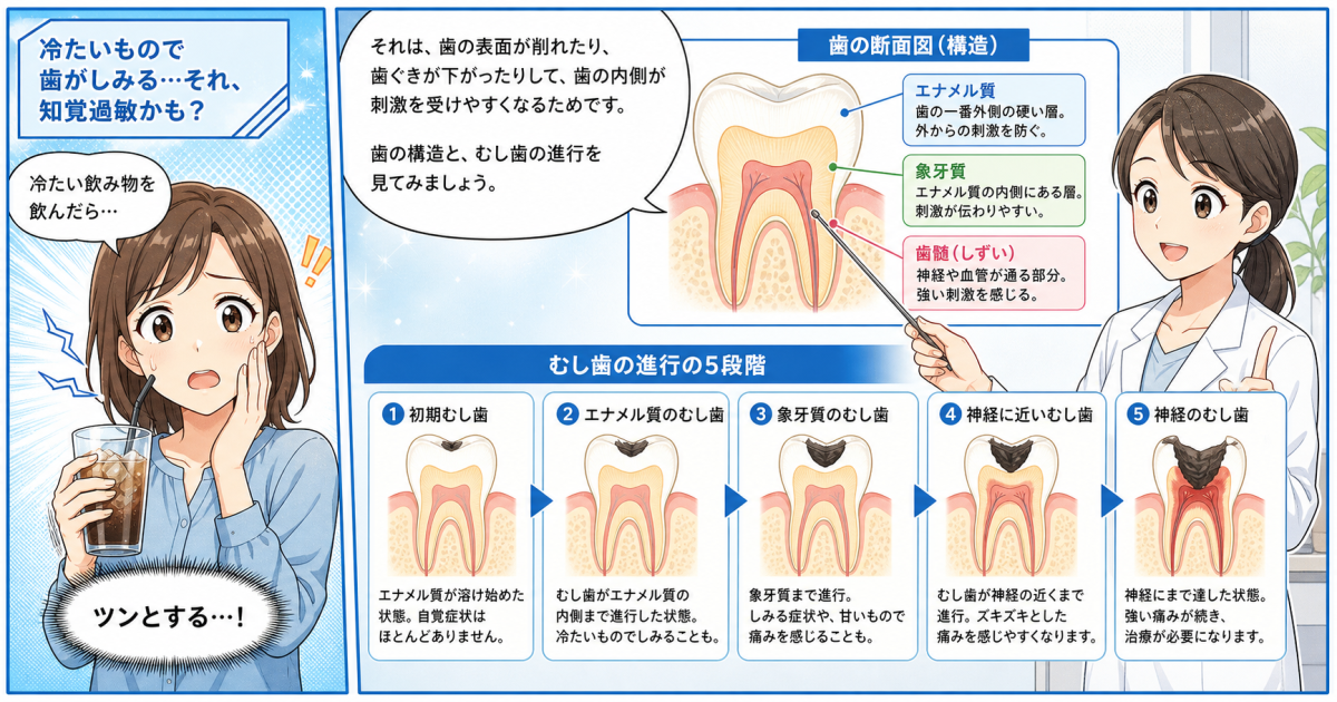 冷たいものがしみる？むし歯の進行段階C0〜C4と発生メカニズム