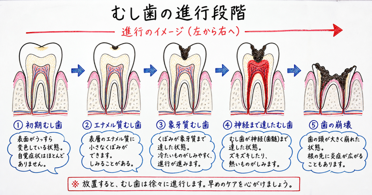 冷たいものがしみる原因とは？むし歯が発生・進行するメカニズム