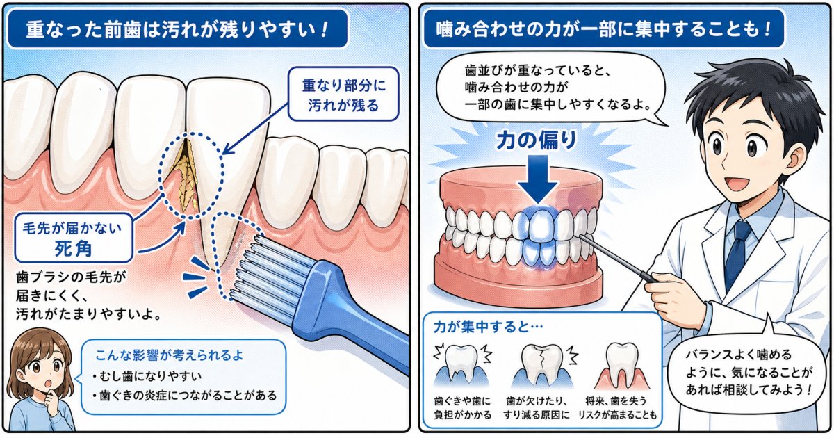 叢生(乱ぐい歯)があるとむし歯や歯周病になりやすい3つの理由