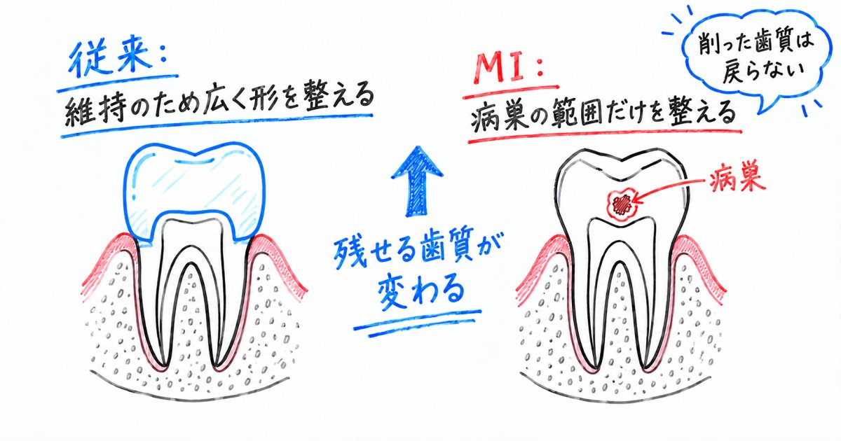 MI治療とは？歯を削る量を抑えて寿命を延ばす基本方針