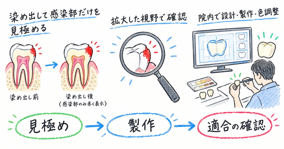 削りすぎを防ぎ天然歯を守るための精密設備と修復技術