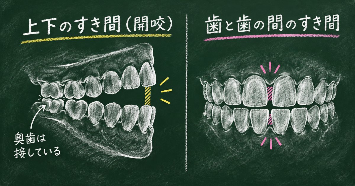 奥歯を閉じても前歯に隙間があると、開咬なの?
