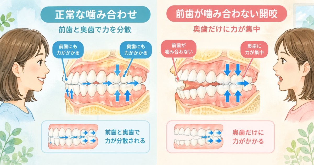 なぜ前歯が噛み合わないと奥歯に負担がかかり、すり減りやすくなるの？
